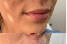 Mika Justen: Especialista em harmonização facial inaugura consultório em Lontras